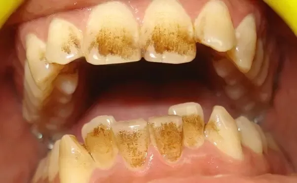 does green tea color your teeth
