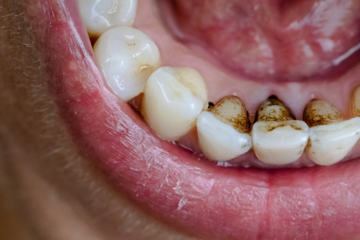 The Ultimate Guide to Black Tea Stains on Teeth: Prevention & Removal
