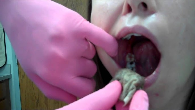 how long to bite on tea bag after extraction