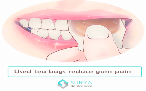 tea bag for tooth pain
