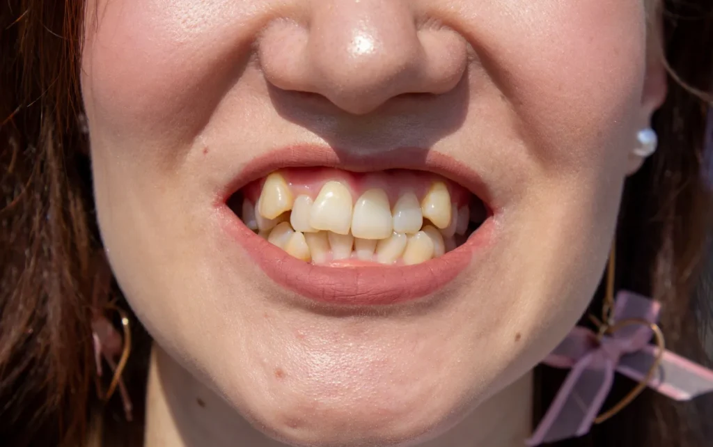 does green tea color your teeth