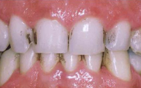 does green tea color your teeth