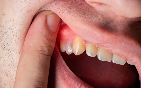 tea bag for tooth extraction